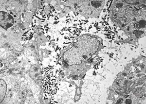 M,54y. | Whipple disease - duodenum